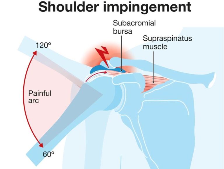 Shoulder Impingement Syndrome Causes Symptoms Treatment